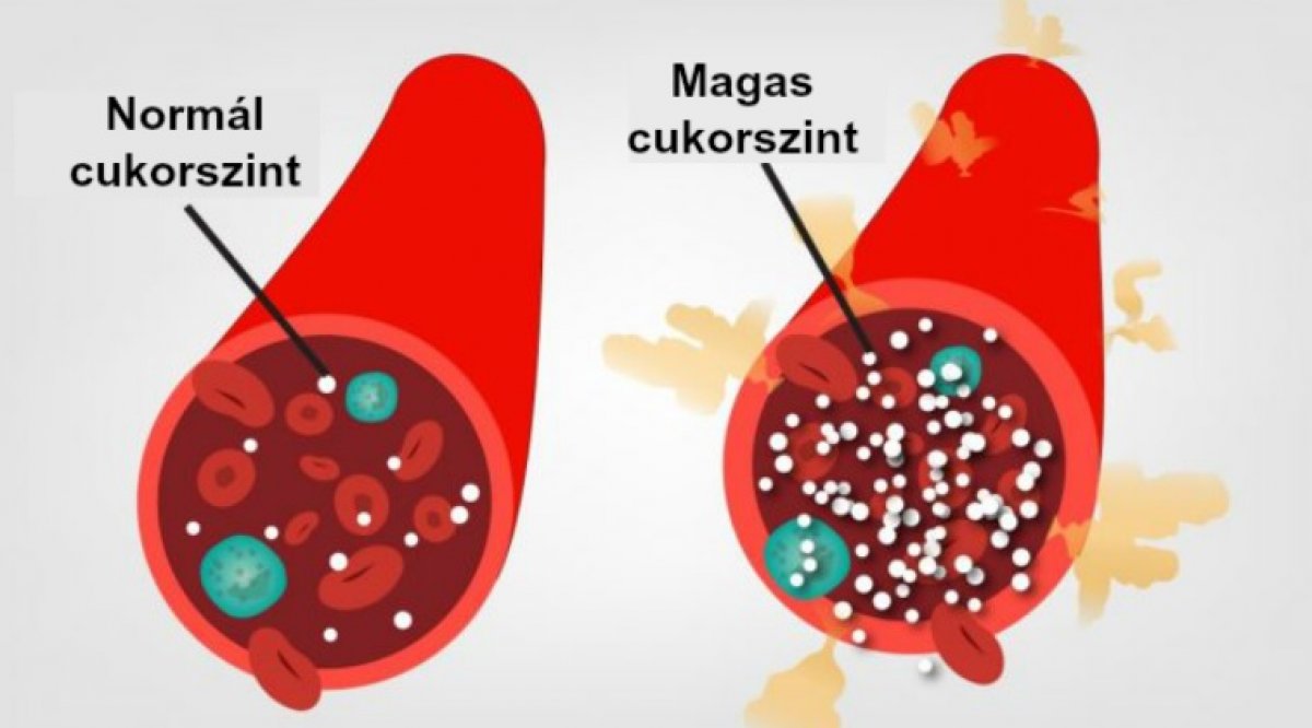 magas vércukorszint Hiperglikémia